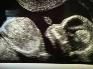 Blac Chyna Rob Kardashian ultrasound