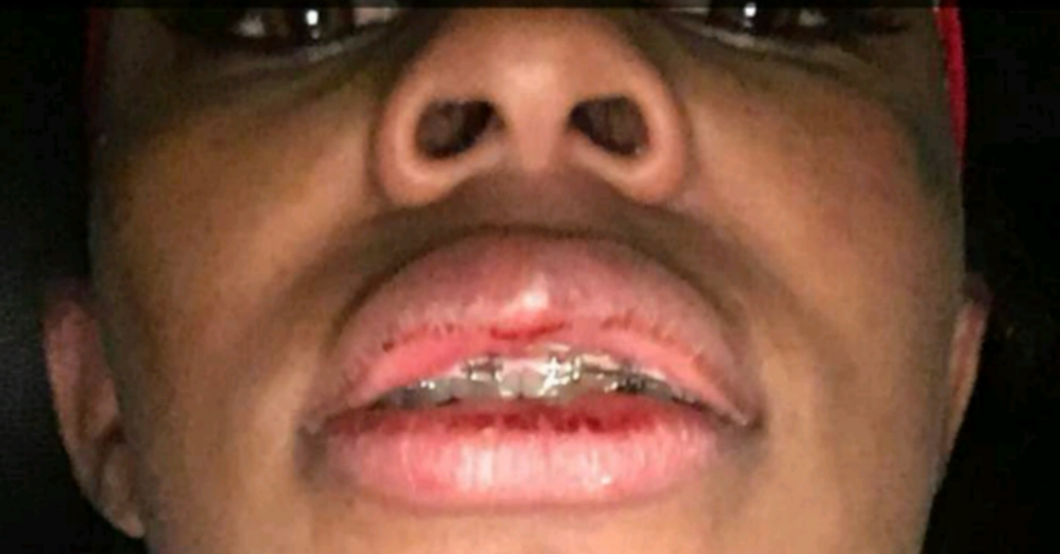 Rich Girl My Chief Keef busted lip